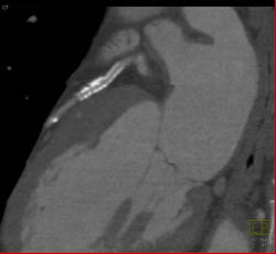 LAD Disease With Extensive Calcified Plaque - CTisus CT Scan