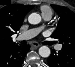 Bypass Grafts Including Left Internal Mammary Artery (LIMA) and Venous Grafts - CTisus CT Scan