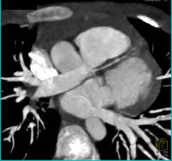 Enlarged Pulmonary Artery - CTisus CT Scan