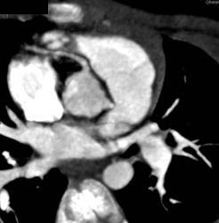 Poor Cardiac CT Study Due to Error in Table Speed During the Study - CTisus CT Scan