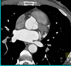 Nice Definition of Conus Branch Off RCA - CTisus CT Scan