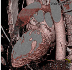 3D Imaging of Circumflex Artery and Its Pathway in Multiple Renderings in Left Dominant Circulation - CTisus CT Scan