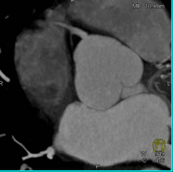 Normal RCA in Right Dominant Circulation- See Sequence of Renderings - CTisus CT Scan