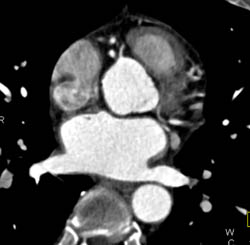 Conus Branch Directly Off Right Cusp - CTisus CT Scan