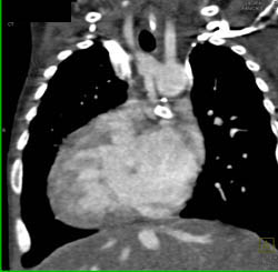 Complex Cardiac Anomalies With Dextrocardia - CTisus CT Scan