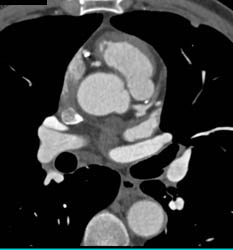 Plaque in RCA and LAD - CTisus CT Scan