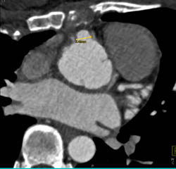 Aneurysmal Dilation of RCA Post Reimplantation - CTisus CT Scan