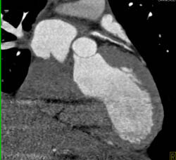 LAD Plaque With Approximately 50% Stenosis- Non-calcified Plaques - CTisus CT Scan