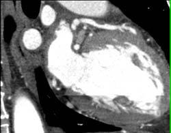 LAD Plaque With Agatston Score of 0 - CTisus CT Scan