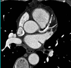 Calcified Plaque in LAD, Circumflex, and RCA - CTisus CT Scan