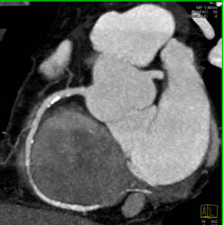 RCA Plaque - CTisus CT Scan