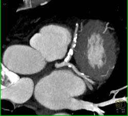 LAD Plaque - CTisus CT Scan