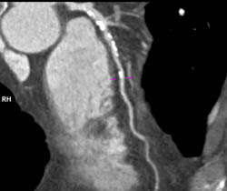 LAD Plaque - CTisus CT Scan