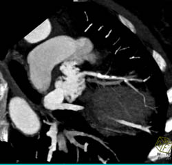 LAD Plaque - CTisus CT Scan