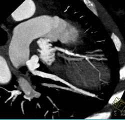 LAD Plaque - CTisus CT Scan