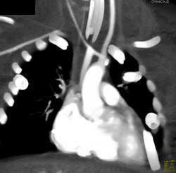 Patent Bt Shunt - CTisus CT Scan