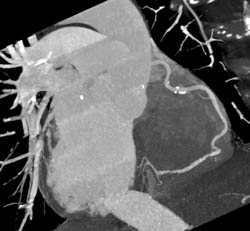 Diseased RCA With MIP Imaging - CTisus CT Scan