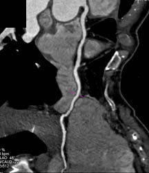 LAD With Minimal Plaque - CTisus CT Scan