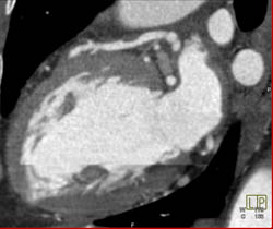 LAD Disease - CTisus CT Scan