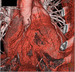 LAD Disease - CTisus CT Scan