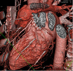 LAD Disease - CTisus CT Scan