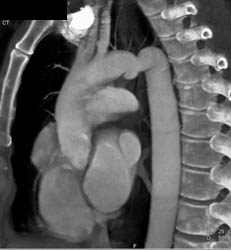 Pseudo Coarctation With Small Dissection Near Site of Prior Trauma - CTisus CT Scan