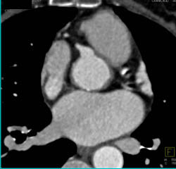 Dilated RCA at Origin - CTisus CT Scan