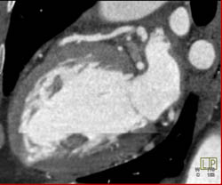 LAD Plaque - CTisus CT Scan