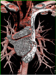 Persistent Left Superior Vena Cava (SVC) Into Coronary Sinus - CTisus CT Scan