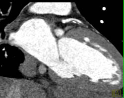 LAD Plaque - CTisus CT Scan