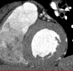 LAD Plaque - CTisus CT Scan