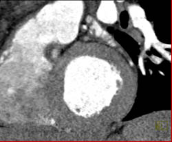 LAD Plaque - CTisus CT Scan