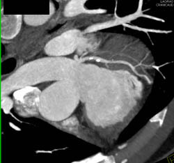 LAD Plaque - CTisus CT Scan