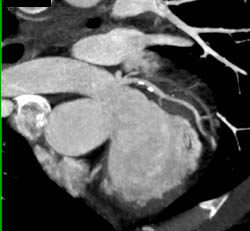 LAD Plaque - CTisus CT Scan