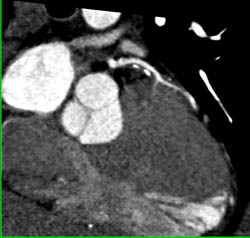 LAD Plaque - CTisus CT Scan