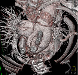 Aortic Arch With Elephant Trunk Repair - CTisus CT Scan