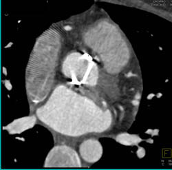 Dilated Origin of RCA - CTisus CT Scan