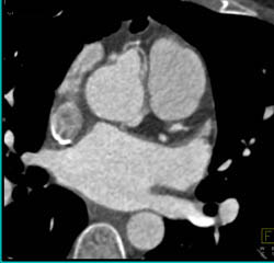 Dilated RCA and Left Main Coronary Artery at Root - CTisus CT Scan