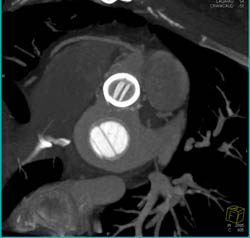 Aortic and Mitral Valve Replacement - CTisus CT Scan