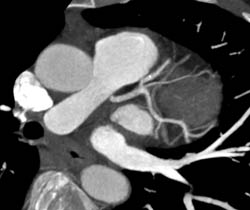 Ramus Intermedius and Trifurcation - CTisus CT Scan