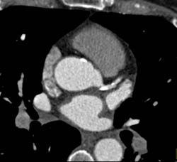 Plaque- Calcified and Non-calcified- in LAD - CTisus CT Scan