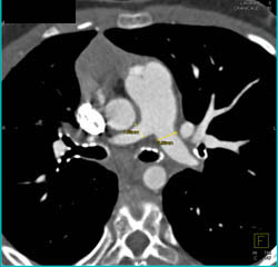 Pulmonary Artery Stenosis - CTisus CT Scan