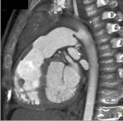 Patent PDA (Patent Ductus Arteriosus) - CTisus CT Scan