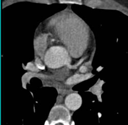 Plaque in LAD - CTisus CT Scan