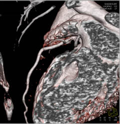 Plaque in LAD With Different Renderings - CTisus CT Scan