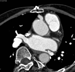 Dilated Origin of RCA and Left Main Coronary Artery - CTisus CT Scan