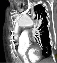 S/P Aortic Root Repair - CTisus CT Scan