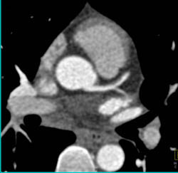 Plaque in LAD - CTisus CT Scan