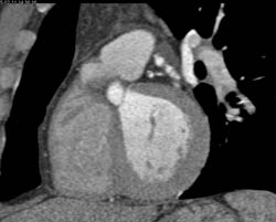 Plaque in LAD - CTisus CT Scan