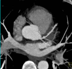 Plaque in LAD - CTisus CT Scan